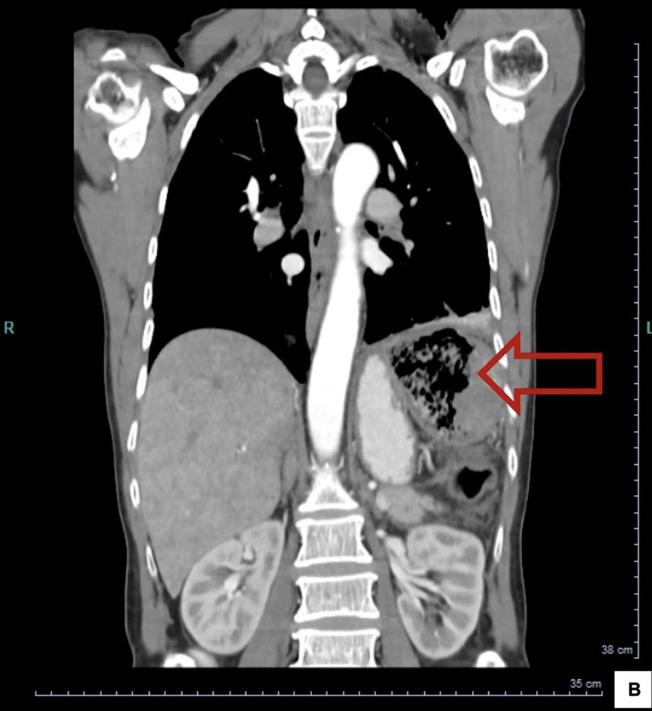 Bác sĩ để quên miếng gạc 20 năm trong người bệnh nhân woman gauze strip inside body 04 1663409621 43