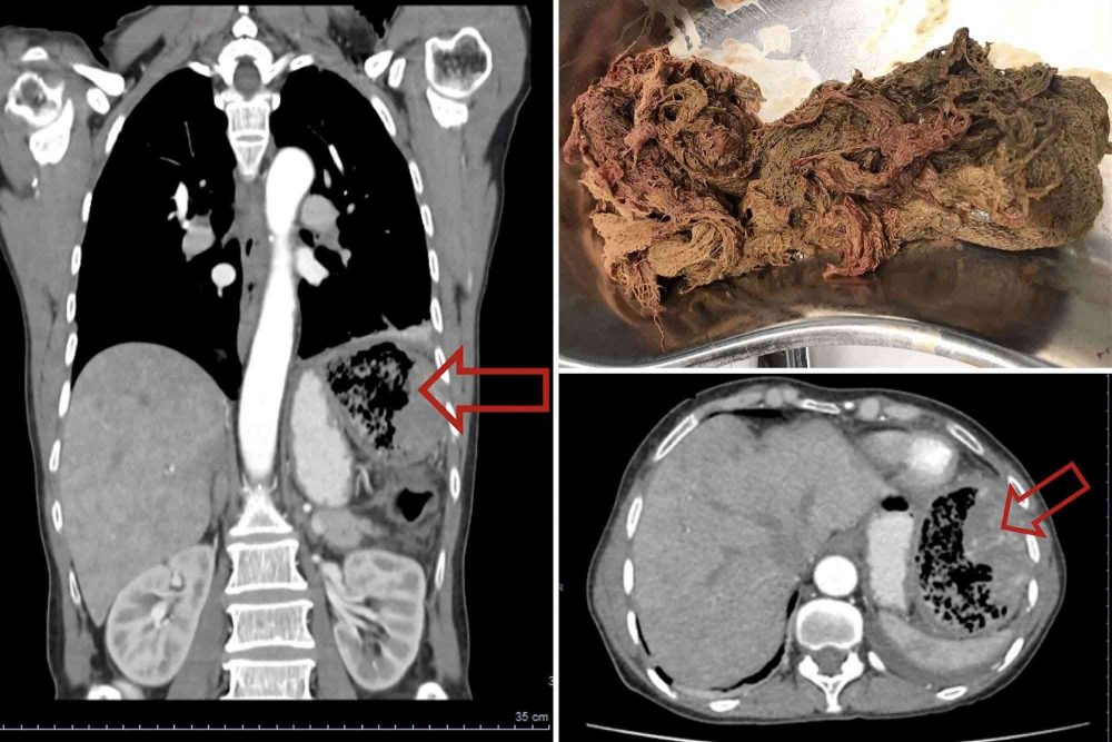 Bác sĩ để quên miếng gạc 20 năm trong người bệnh nhân woman gauze strip inside body comp 1 1663409633 78