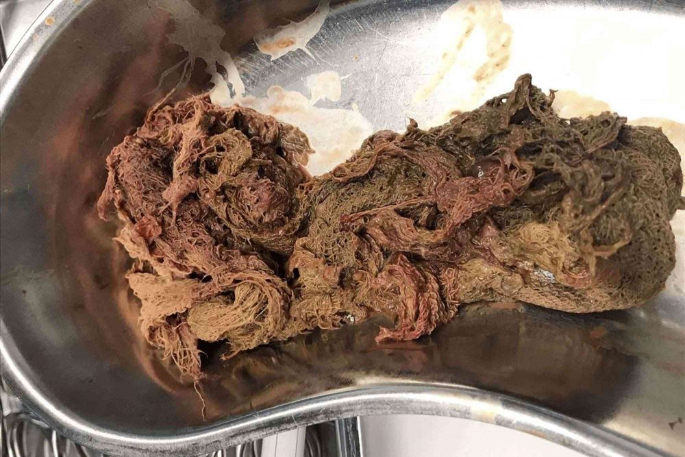 Bác sĩ để quên miếng gạc 20 năm trong người bệnh nhân woman gauze strip inside body feat image 1663409638 17