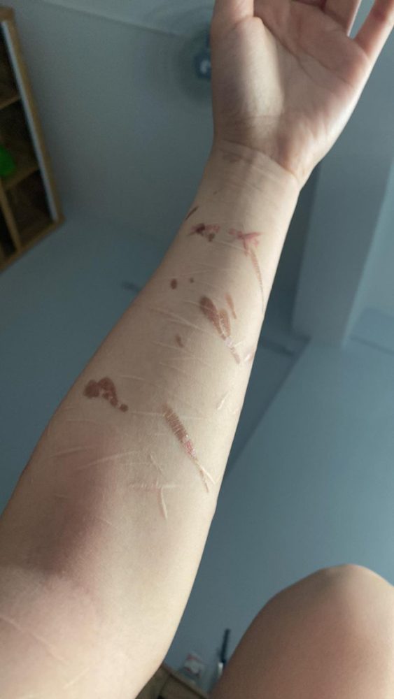 photo-2-1681134500213962831886-1681175125029-16811751254961532591119 Hot girl người Tày Ceri Thu Hà lần đầu nói về các vết thương chằng chịt trên cánh tay photo 2 1681134500213962831886 1681175125029 16811751254961532591119