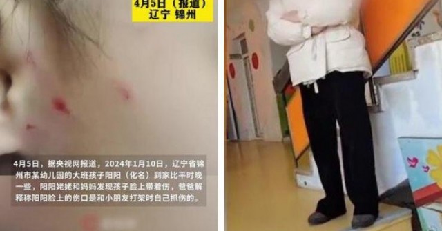 TQ: Cô giáo mầm non làm xước mặt bé 6 tuổi, phải bồi thường 140 triệu 0 1744258735 648 width740height495 auto cropjpg 1