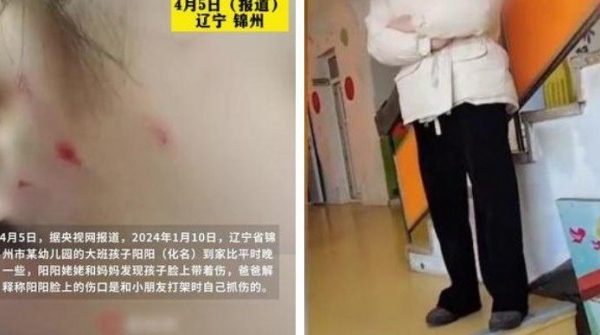 TQ: Cô giáo mầm non làm xước mặt bé 6 tuổi, phải bồi thường 140 triệu 0 1744258735 648 width740height495 auto cropjpg