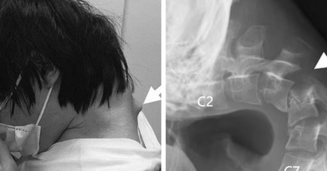 Sốc: Chàng trai nghiện game đến mức cổ cong 90 độ 0 1747373393 14 width740height495 auto cropjpg 1