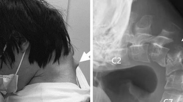 Sốc: Chàng trai nghiện game đến mức cổ cong 90 độ 27 Sốc: Chàng trai nghiện game đến mức cổ cong 90 độ 0 1747373393 14 width740height495 auto cropjpg