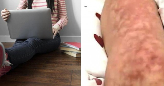 Cô gái hoảng hốt khi thấy trên đùi xuất hiện hoa văn lạ, nguyên nhân không ai ngờ tới 0 2 1739093981 347 width740height495 auto cropjpg 1