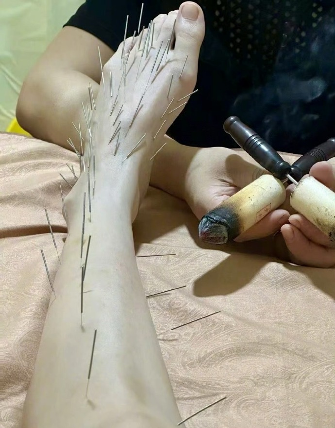 Sốc nặng hình ảnh Trần Kiều Ân cắm hàng trăm chiếc kim khắp cơ thể, làm đẹp mà chấp nhận đau đớn không tưởng!- Ảnh 3.