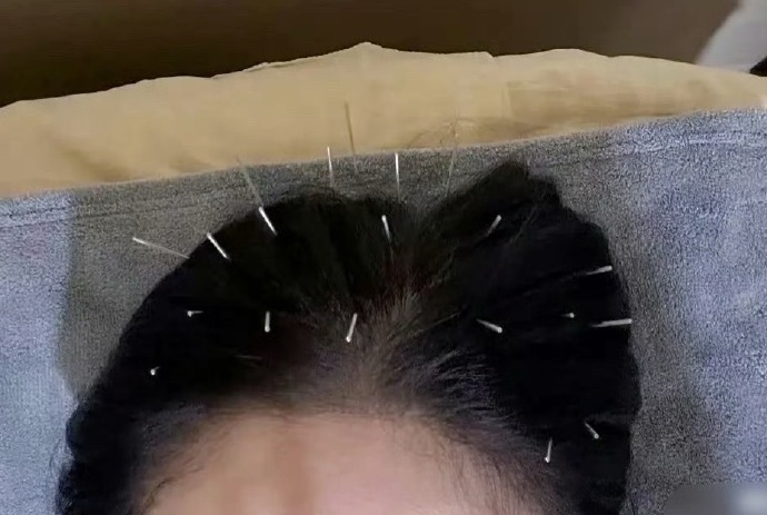 Sốc nặng hình ảnh Trần Kiều Ân cắm hàng trăm chiếc kim khắp cơ thể, làm đẹp mà chấp nhận đau đớn không tưởng!- Ảnh 2.