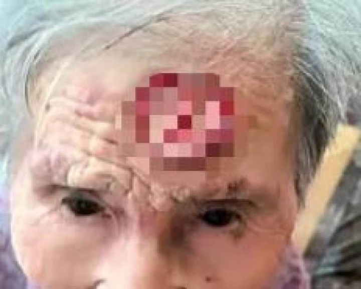 Cụ bà 98 tuổi dùng kéo cắt 'sừng trường thọ' trên trán, dẫn đến nguy kịch- Ảnh 1.