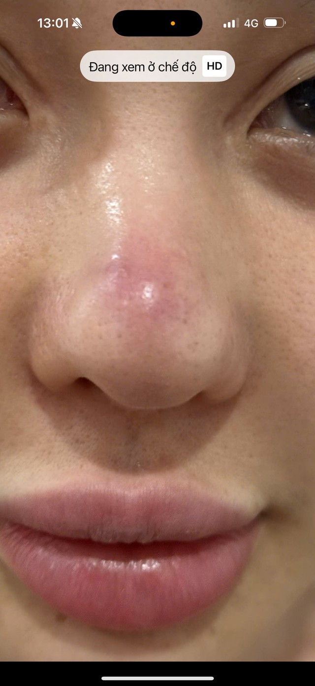 DJ Ngân 98 thản nhiên ăn hải sản khi mũi đang bị biến chứng nhiễm trùng nặng?- Ảnh 6.