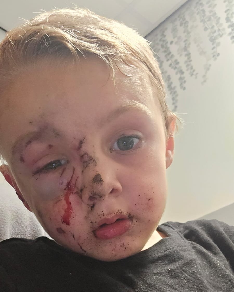 Bé trai 5 tuổi bị chó dữ tấn công khi đang đi dạo ở công viên- Ảnh 2. Bé trai 5 tuổi bị chó dữ tấn công khi đang đi dạo ở công viên- Ảnh 2.