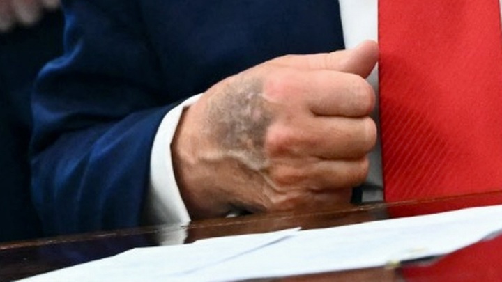Bàn tay thâm tím của ông Trump gây chú ý- Ảnh 1.