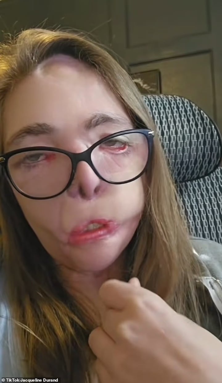 Cô gái bị chó dữ cắn 800 nhát trên mặt có diện mạo mới sau 4 năm phẫu thuật- Ảnh 3.