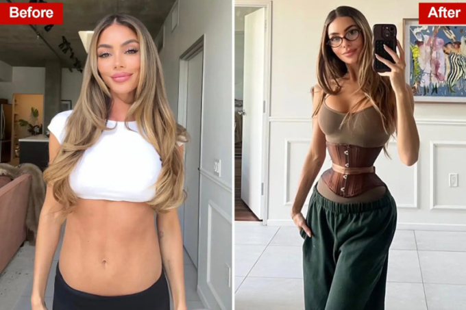 Cô gái 28 tuổi chi 362 triệu, cắt 6 xương sườn để có vòng eo con kiến - trào lưu thẩm mỹ kinh hoàng quay trở lại- Ảnh 4.