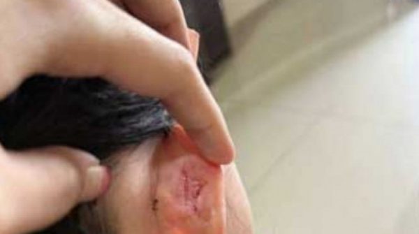 Malaysia: Bé gái bị cô giáo véo đến rách tai khiến cư dân mạng phẫn nộ 1741316092 61 thumbnail width740height495 anh cat 3 2 auto cropjpg