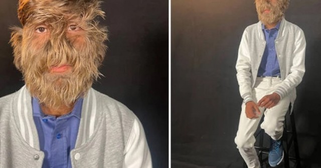 Chàng trai lập kỷ lục Guinness là "Người có lông mặt dày nhất" 1741839658 942 thumbnail width740height495 anh cat 3 2 auto cropjpg 1