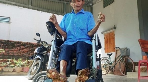 Cuộc sống của người đàn ông mắc bệnh 'người cây' hiếm gặp ở Ninh Bình 1761006476 662 thumbnail width740height495 anh cat 3 2 auto cropjpg