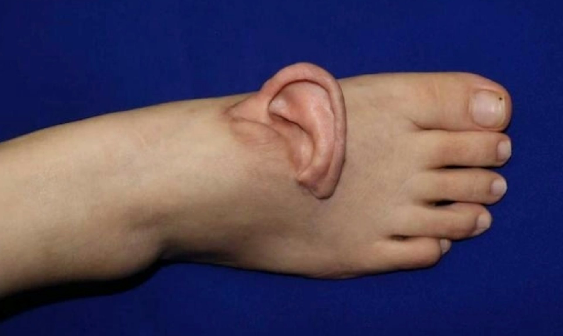 Nối lại tai đã đứt rời sau khi nuôi ở bàn chân suốt 5 tháng- Ảnh 1. Nối lại tai đã đứt rời sau khi nuôi ở bàn chân suốt 5 tháng- Ảnh 1.