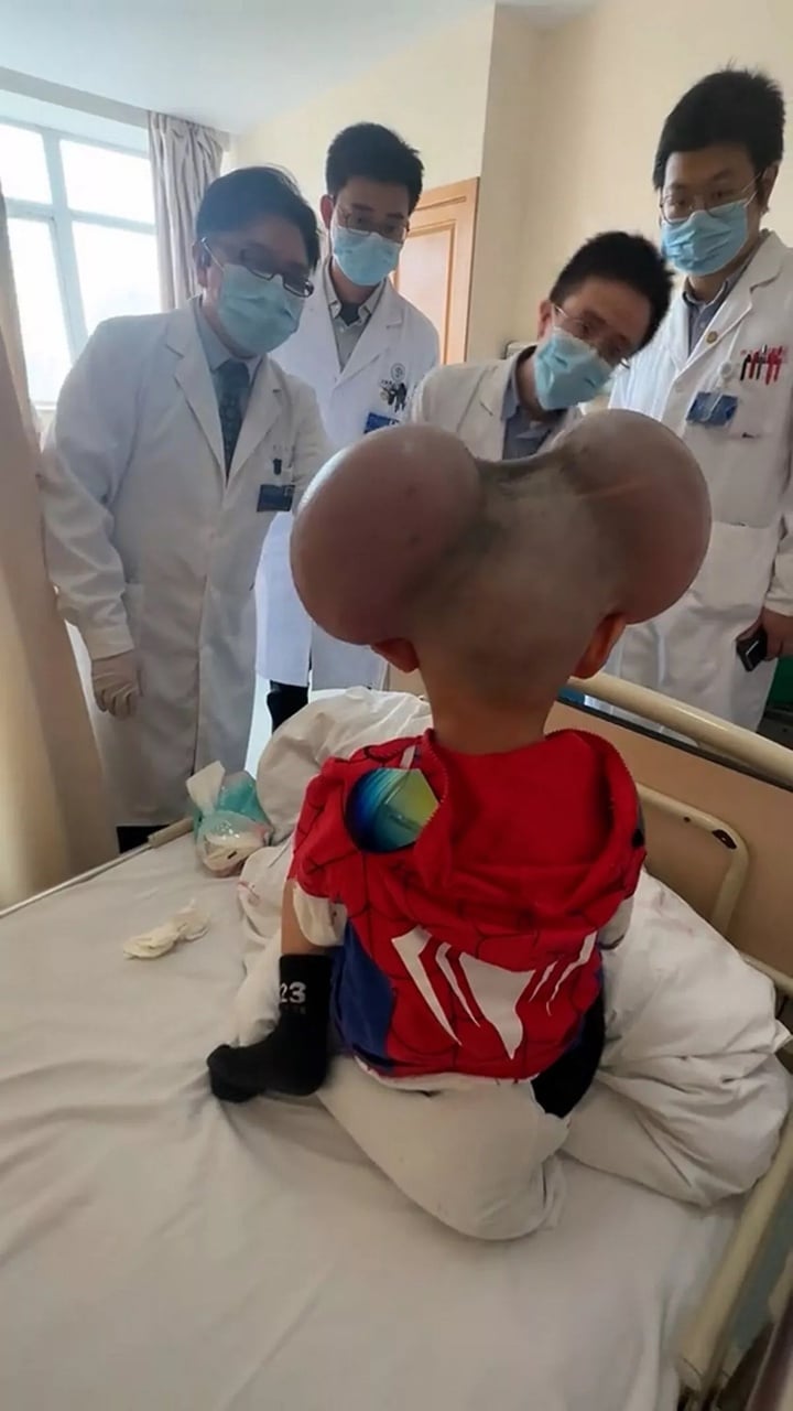 Nốt ruồi khổng lồ phủ kín hộp sọ khiến cậu bé có ngoại hình giống chuột Mickey- Ảnh 2.