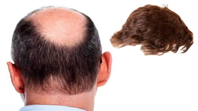 Cô dâu ngất xỉu khi phát hiện chú rể bị hói đầu trong đám cưới- Ảnh 1.