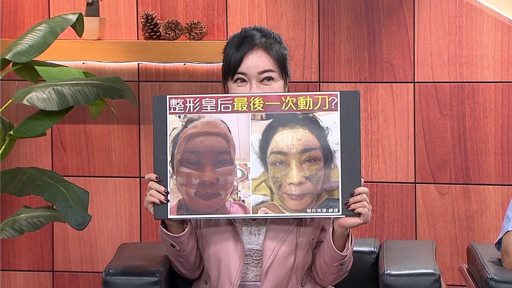 "Nữ hoàng dao kéo" chuyển từ giường bệnh ung thư sang… giường phẫu thuật thẩm mỹ, gây mê suốt 6 tiếng để căng da! 20250731002375 1753966912148 17539669126611612463586