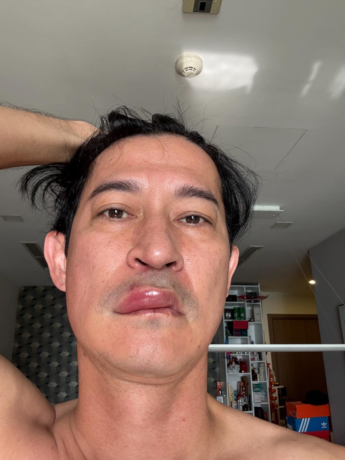 Sao nam Vbiz phát hoảng vì mặt biến dạng, sưng phồng bất thường- Ảnh 1. Sao nam Vbiz phát hoảng vì mặt biến dạng, sưng phồng bất thường- Ảnh 1.