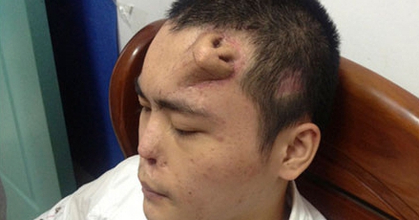 Không phải ảnh lỗi của AI, người đàn ông này đã thực sự mọc một chiếc mũi trên trán: Đó là "tác phẩm" của các bác sĩ Trung Quốc 28 Không phải ảnh lỗi của AI, người đàn ông này đã thực sự mọc một chiếc mũi trên trán: Đó là "tác phẩm" của các bác sĩ Trung Quốc 4889106 1750904894208723493661 1750930312859 17509303130531152796032 0 0 341 545 crop 175093033936 0 0 317 507 crop 1750930 13 0 287 439 crop 17509303651242127609545jpeg