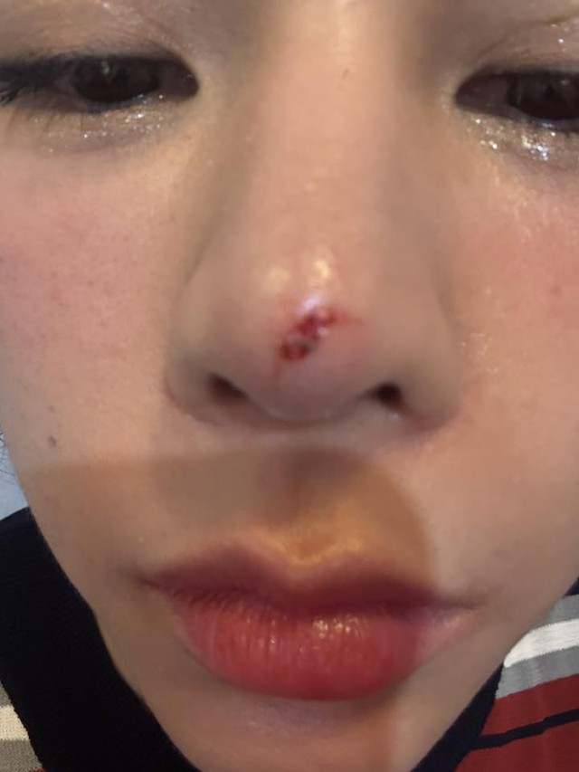 Thêm sao nữ Vbiz gặp tai nạn trên sân pickleball, vết thương chảy máu giữa mặt- Ảnh 2.