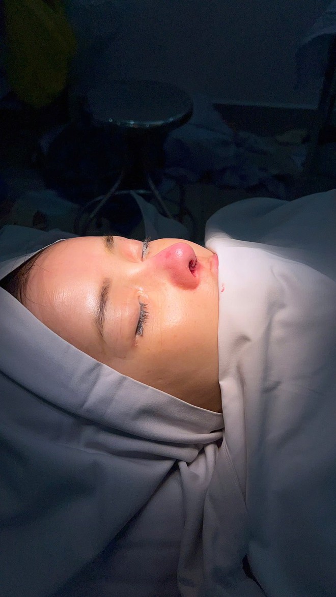 Ngân 98 bị biến chứng nhiễm trùng nặng sau 11 lần phẫu thuật thẩm mỹ- Ảnh 5.