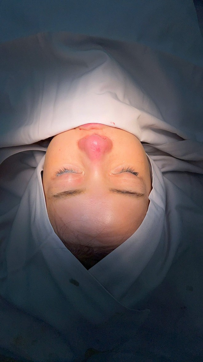 Ngân 98 bị biến chứng nhiễm trùng nặng sau 11 lần phẫu thuật thẩm mỹ- Ảnh 4.