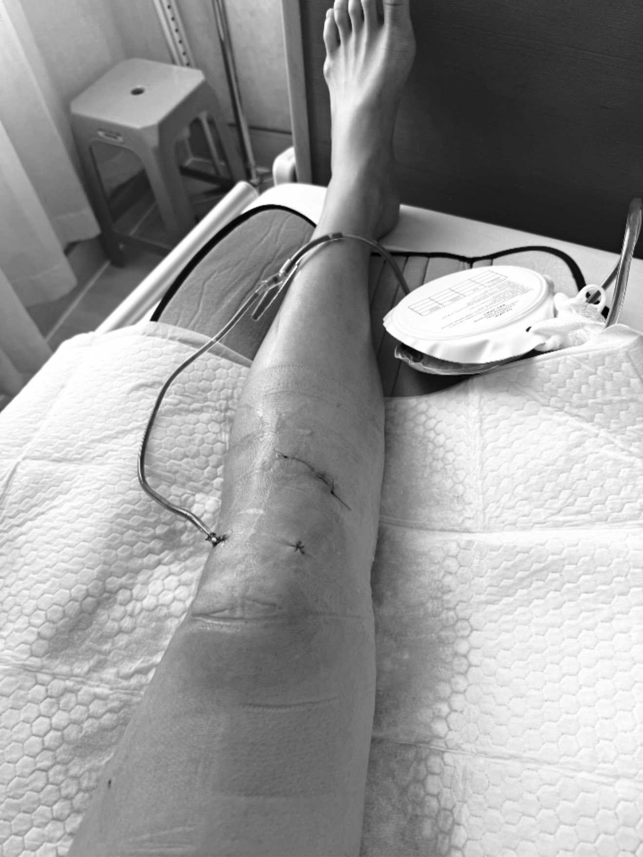 Siêu mẫu Minh Tú sốc vì bị đứt dây chằng chéo trước, rách sụn, dập xương- Ảnh 1.