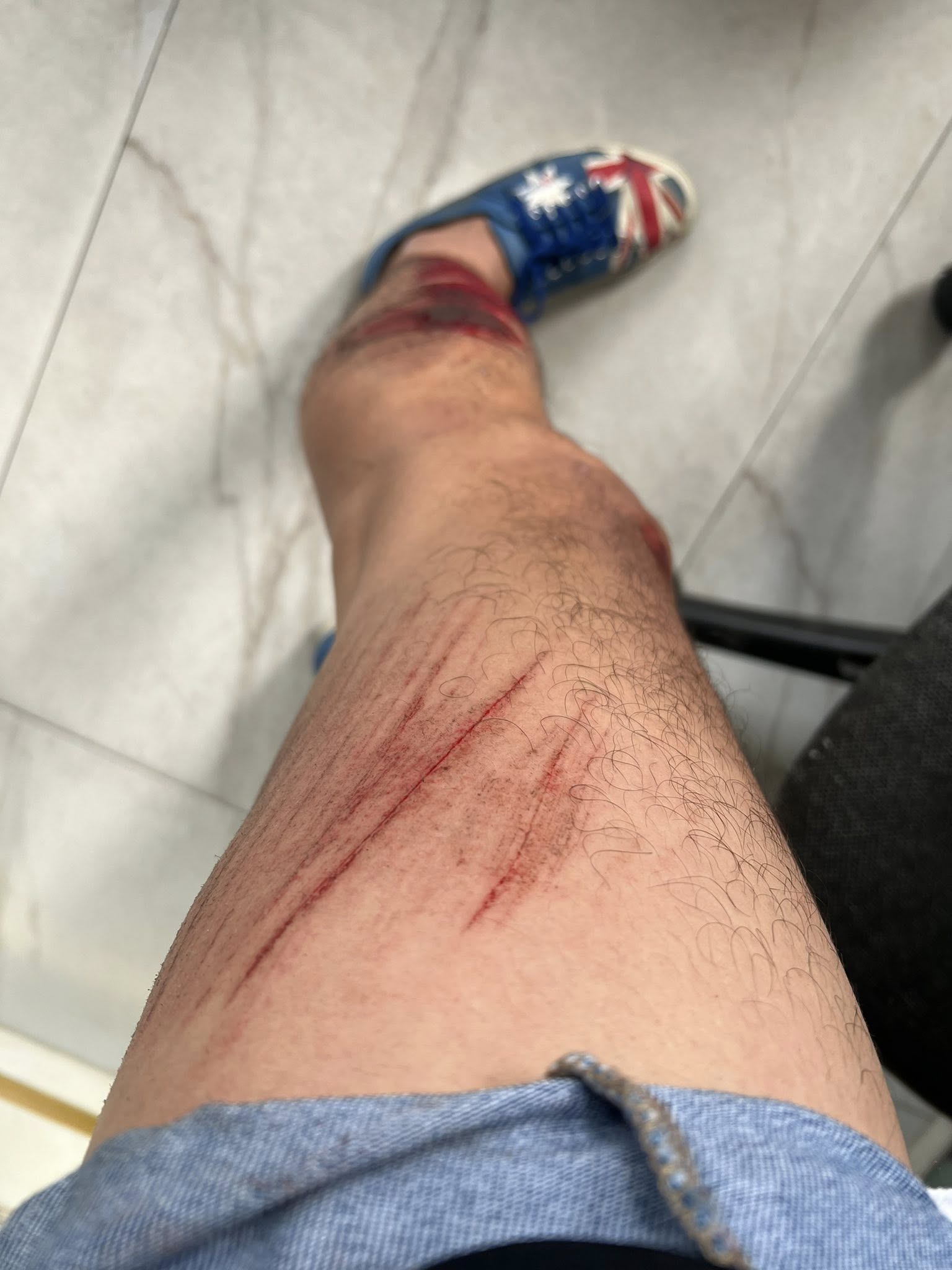 Quách Ngọc Tuyên bị tai nạn- Ảnh 2.