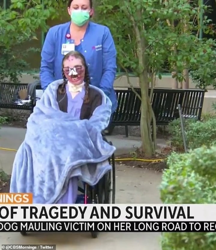 Cô gái bị chó dữ cắn 800 nhát trên mặt có diện mạo mới sau 4 năm phẫu thuật- Ảnh 1.