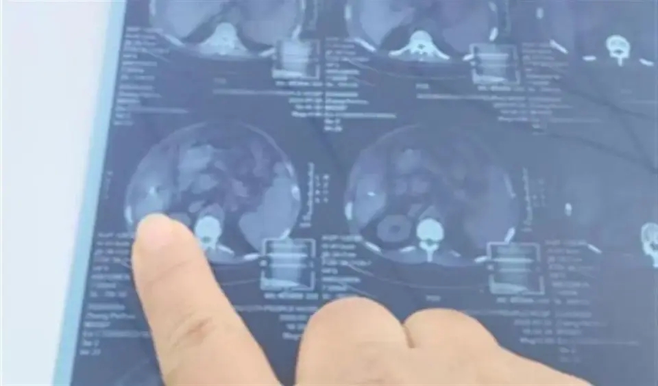 Kim 15mm sót trong gan bệnh nhân nhưng không thể lấy ra, bệnh viện khẳng định: