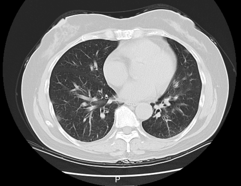 Một nhà 5 người đồng loạt mắc cúm sau chuyến đi chơi, có người biến chứng nặng, trắng phổi vì bỏ lỡ