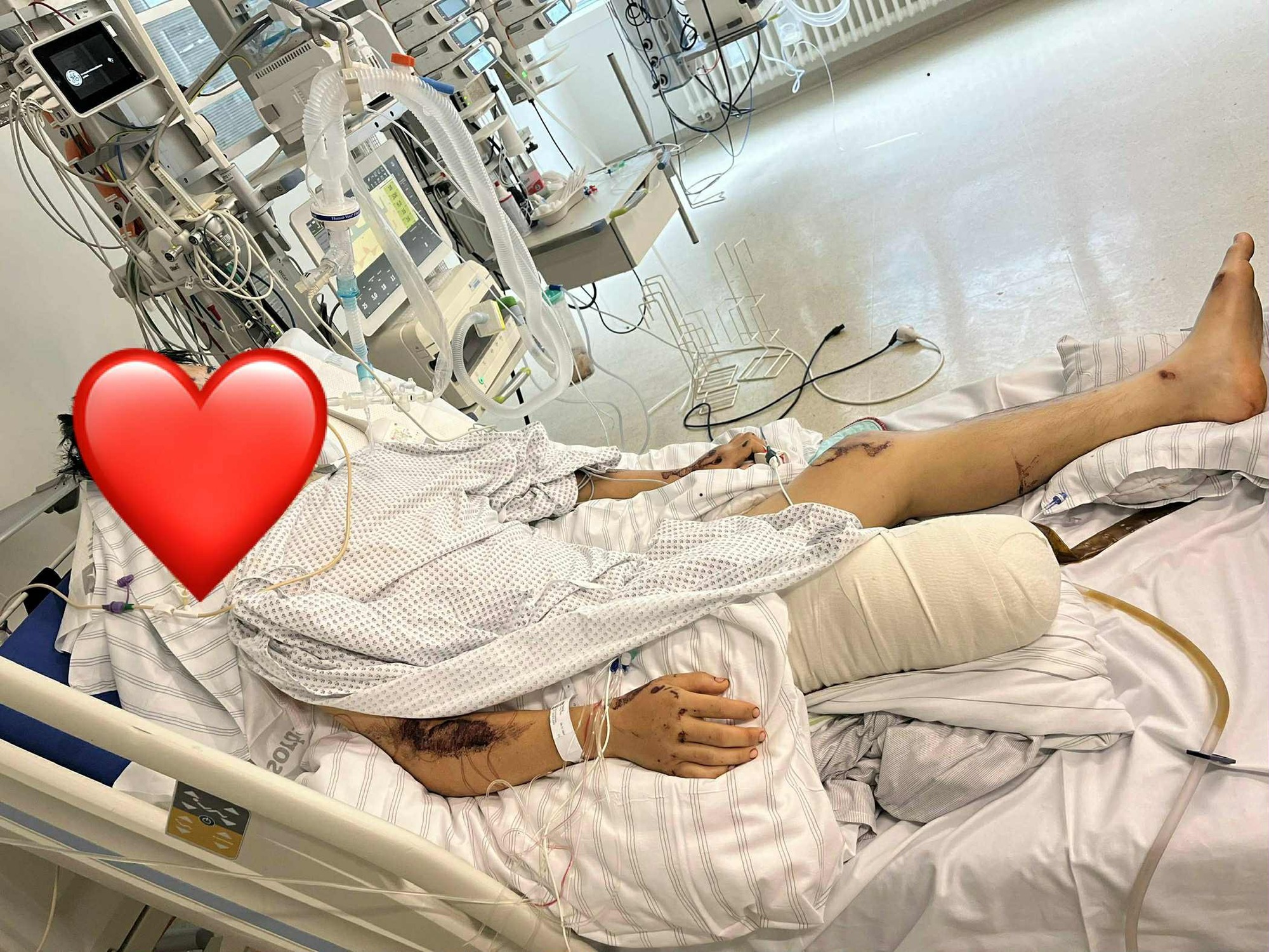 Vụ Tiktoker Bốp cùng cặp đôi song sinh gặp nạn tại Đức: Phẫn nộ khi nghi phạm sử dụng bóng cười, bỏ trốn sau khi gây tai nạn- Ảnh 2. Vụ Tiktoker Bốp cùng cặp đôi song sinh gặp nạn tại Đức: Phẫn nộ khi nghi phạm sử dụng bóng cười, bỏ trốn sau khi gây tai nạn- Ảnh 2.