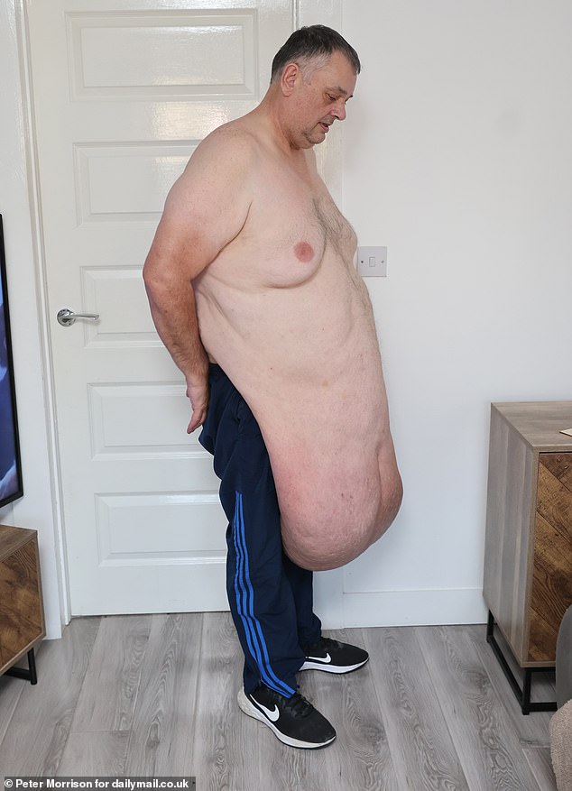 Ác mộng giảm cân: Người đàn ông với khối da thừa khổng lồ khiến các bác sĩ cũng sốc- Ảnh 1.