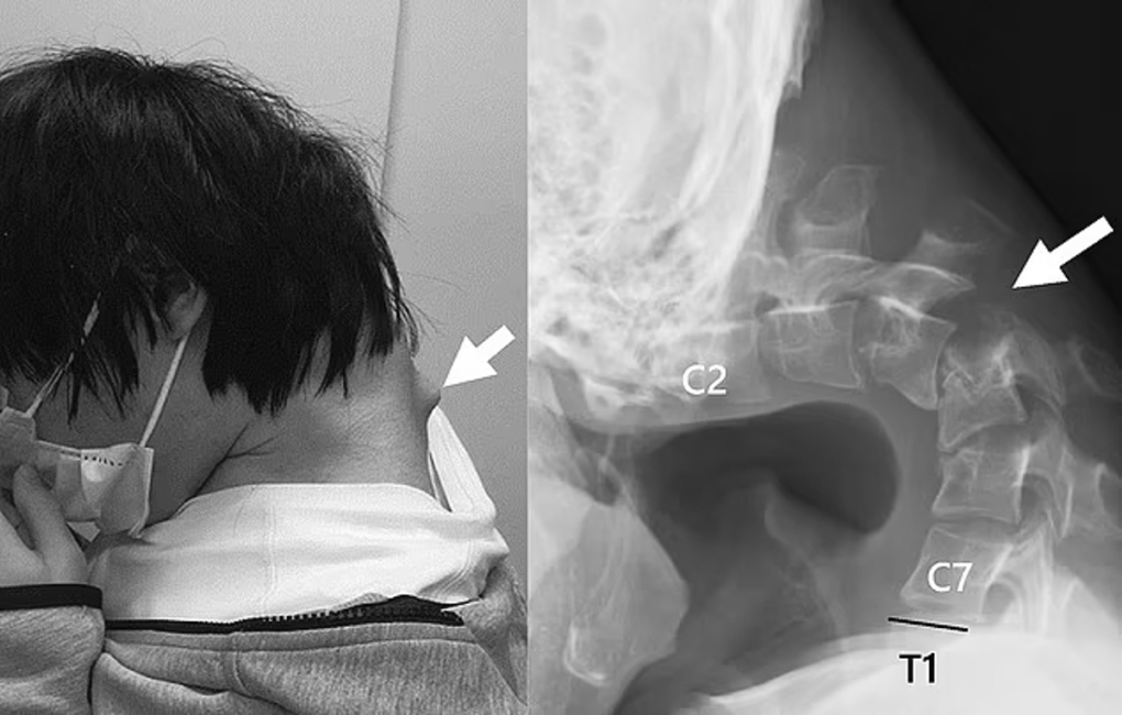 Cô gái 20 tuổi sở hữu cột sống cổ của người 60 vì nghiện chơi game- Ảnh 2. Cô gái 20 tuổi sở hữu cột sống cổ của người 60 vì nghiện chơi game- Ảnh 2.