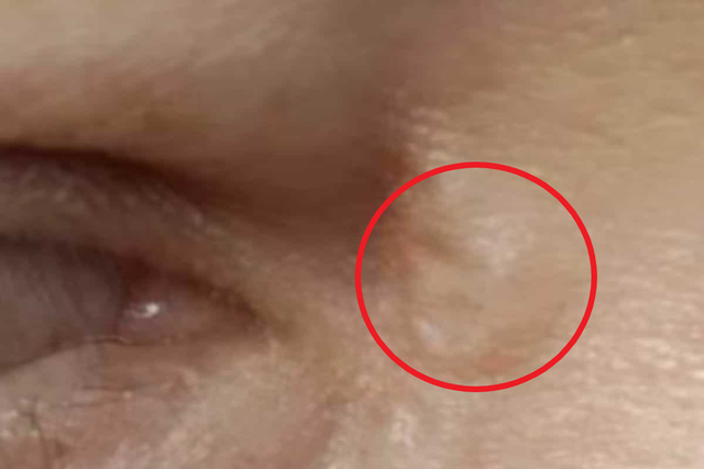 Khối u nhỏ xuất hiện gần mắt, 1 thời gian sau người phụ nữ tá hỏa thấy 1 sinh vật lạ sống trên mặt mình- Ảnh 1.