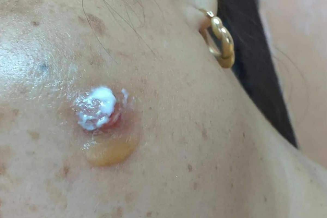 Khối u nhỏ xuất hiện gần mắt, 1 thời gian sau người phụ nữ tá hỏa thấy 1 sinh vật lạ sống trên mặt mình- Ảnh 2.