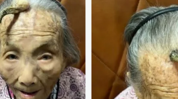 Cụ bà 107 tuổi bỗng mọc "sừng" trên trán, cộng đồng mạng bàn tán đưa ra lời khuyên adt1748052622 cu ba 107 tuoi bong moc sung truong anh cat 3 2 auto croppng
