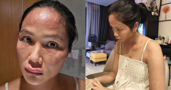 Gương mặt biến dạng sau sinh của H'Hen Niê 29 Gương mặt biến dạng sau sinh của H'Hen Niê ava 13 176120859109890323605 17 0 268 480 crop 1761208607753709520571png