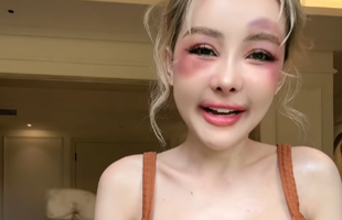 Nữ hoàng thẩm mỹ Ngân 98 gặp sự cố đau đớn, hé lộ về lần phẫu thuật tiếp theo avatar1735811786836 17358117875201228595001png