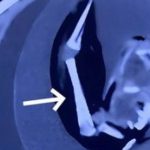 Đầu bé gái to bất thường, bác sĩ sốc nặng khi phát hiện thứ bên trong avatar1738317168456 1738317168931673938721 0 44 315 548 crop 17383171904132115916395jpg