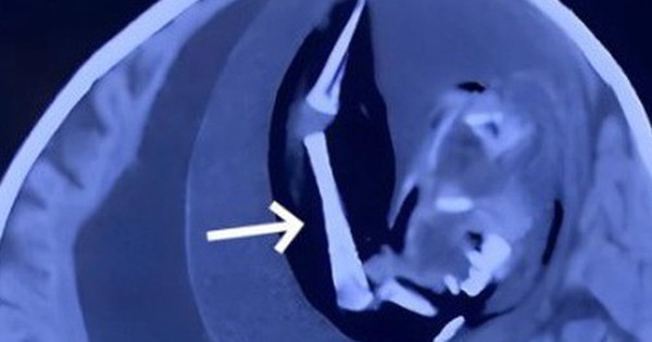 Đầu bé gái to bất thường, bác sĩ sốc nặng khi phát hiện thứ bên trong avatar1738317168456 1738317168931673938721 0 44 315 548 crop 17383171904132115916395jpg