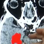 Báo động vi nhựa xâm nhập não người ngày một nhiều avatar1738716545797 1738716546038773070697 66 399 567 1200 crop 17387165765141885211011png