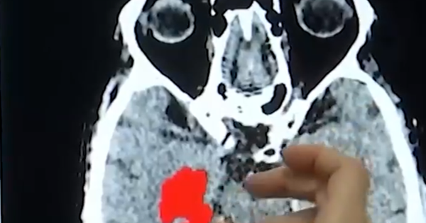 Báo động vi nhựa xâm nhập não người ngày một nhiều avatar1738716545797 1738716546038773070697 66 399 567 1200 crop 17387165765141885211011png