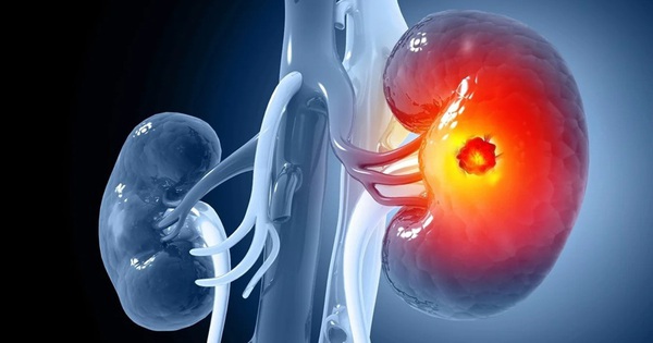 Mỹ: Phát triển vắc-xin chống ung thư thận đột phá avatar1739073698585 1739073698770957189799jpg