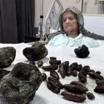 Hãi hùng hình ảnh 63 “hòn đá” được lấy ra từ bụng bà lão 92 tuổi, nguyên nhân đến từ một thói quen sai lầm khi ăn uống avatar1740281264923 17402812652961165377214 23 0 651 1200 crop 1740281286112818013742jpg