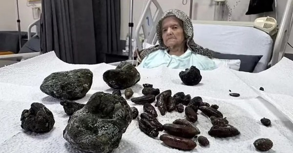 Hãi hùng hình ảnh 63 “hòn đá” được lấy ra từ bụng bà lão 92 tuổi, nguyên nhân đến từ một thói quen sai lầm khi ăn uống avatar1740281264923 17402812652961165377214 23 0 651 1200 crop 1740281286112818013742jpg