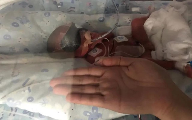 Hy hữu hai trẻ sinh đôi ra đời cách nhau 3 ngày- Ảnh 1. Hy hữu hai trẻ sinh đôi ra đời cách nhau 3 ngày- Ảnh 1.